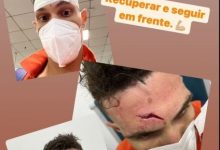 【乐玩LEWIN】慎点！莫伊塞斯晒处理伤口照片：恢复并继续前进-乐玩真人线上娱乐