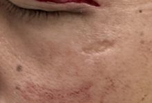 【乐玩LEWIN】惨！河北队鲍亚雄：眼差点瞎医药费自己出，为何毫无底线欺负我们-乐玩真人线上娱乐