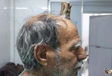 【乐玩LEWIN】印度男子头部长出牛角, 这是怎么回事如今怎样了-乐玩真人线上娱乐