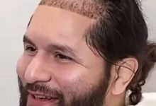 从八角笼到手术台：UFC名将豪尔赫·马斯维达尔赴土耳其植发，大发体育助力你的致富之路！-乐玩真人线上娱乐